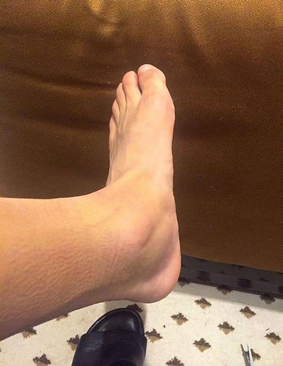 alexis swelling