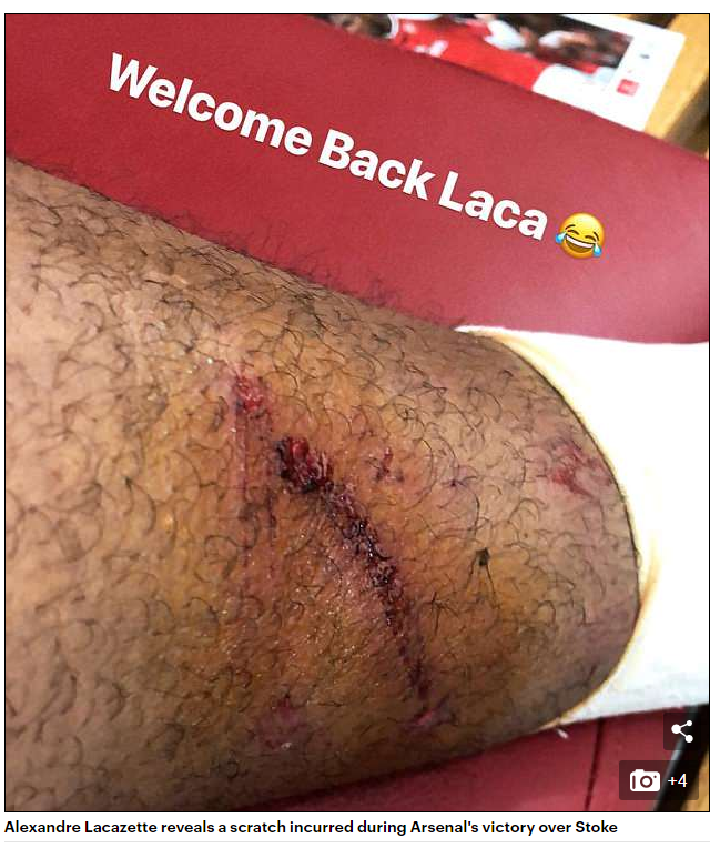 Alexandre Lacazette shows off wound from Stoke game 2 lacazette leg after stoke daily mail
