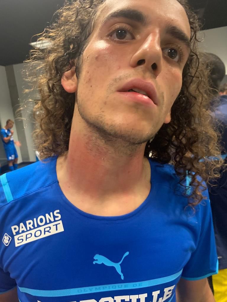 Matteo Guendouzi's red neck after clashes with the OGC Nice fans (Photo via GFFN on Twitter)