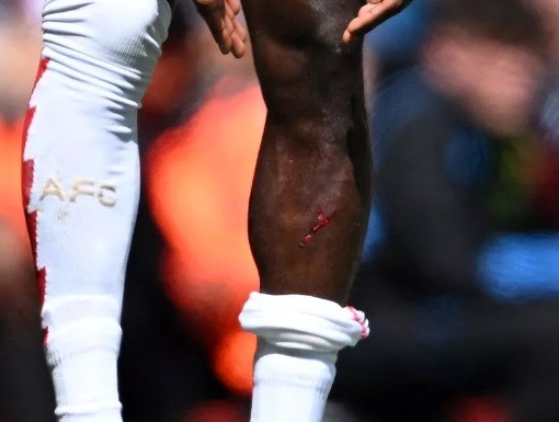 VAR fails Arsenal again: Saka left bloody after appalling challenge 3 Bukao Saka's leg after the Christie 'challenge'